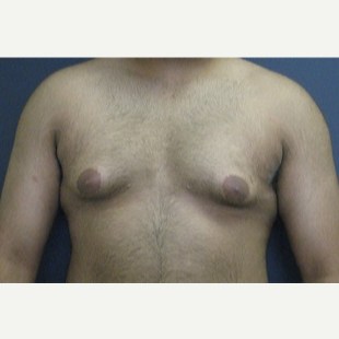 18-24 year old man treated with Male Breast Reduction before 3109273
