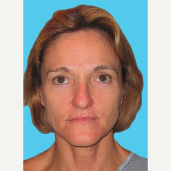 Facelift before 3826869