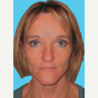 Facelift after 3826869