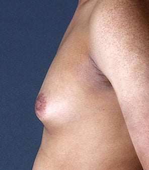 35-44 year old man treated with Gynecomastia before 3126989