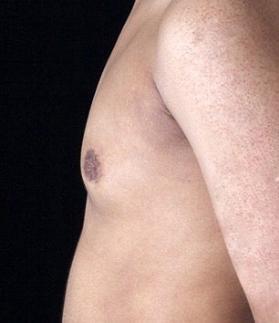 35-44 year old man treated with Gynecomastia after 3126989