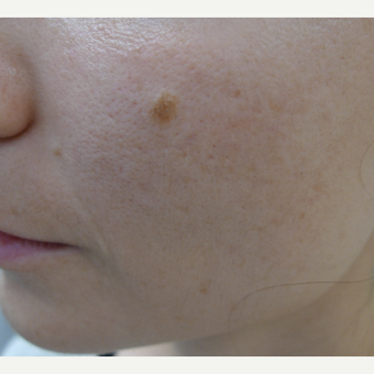 Dark acne scars called PIH treated with lasers after 3084556