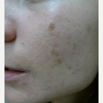 Dark acne scars called PIH treated with lasers before 3084556