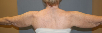 Arm treated with liposuction and ThermiRF skin tightening before 2011289