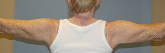Arm treated with liposuction and ThermiRF skin tightening after 2011289