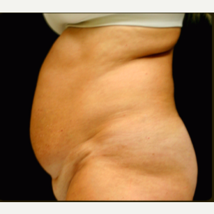 65-74 year old woman treated with Tummy Tuck before 3738086