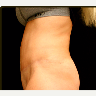 65-74 year old woman treated with Tummy Tuck after 3738086