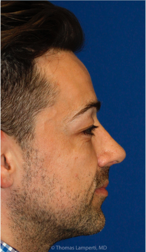 Combined Rhinoplasty and Silicone Chin Implantation after 3672456