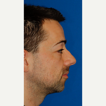 Combined Rhinoplasty and Silicone Chin Implantation before 3672456