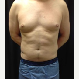 35-44 year old man treated with CoolSculpting to the Abdominal Fat. before 3423838