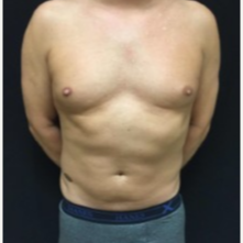 35-44 year old man treated with CoolSculpting to the Abdominal Fat. after 3423838