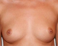 25-34 year old woman with Structured Ideal Implants before 3175569