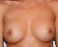 25-34 year old woman with Structured Ideal Implants after 3175569