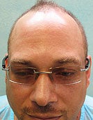 FUE – SFET Using Only Nape and Head Hair for African American Patient before 195668