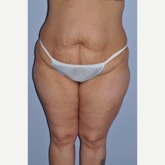 35-44 year old woman treated with Tummy Tuck before 3589980