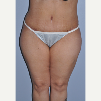 35-44 year old woman treated with Tummy Tuck after 3589980