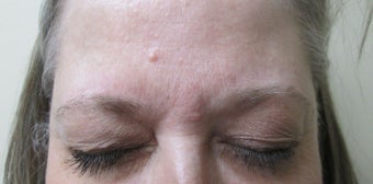 Patient treated for forehead lines after 995319
