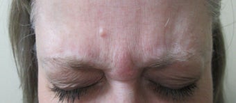 Patient treated for forehead lines before 995319