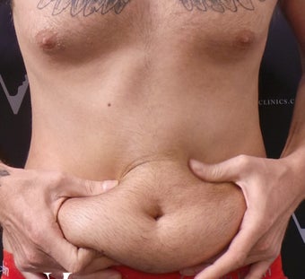 CoolSculpting treatment before 3297324