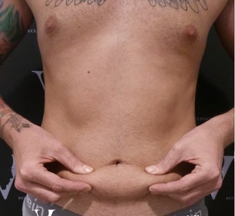 CoolSculpting treatment after 3297324
