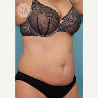 35-44 year old woman treated with Tummy Tuck before 3016641