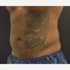 35-44 year old man treated with SculpSure after 3624927
