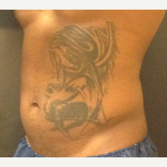 35-44 year old man treated with SculpSure before 3624927