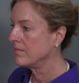 55 year old woman treated with Facelift before 3282902