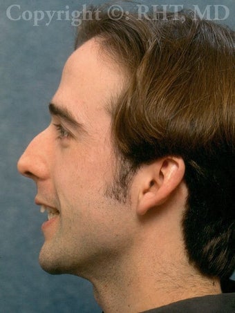 Rhinoplasty before 318339