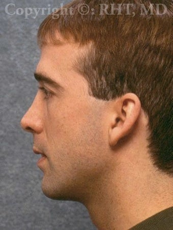 Rhinoplasty after 318339