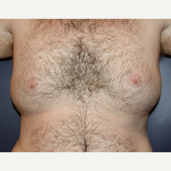 25-34 year old man treated with Male Breast Reduction before 3093966