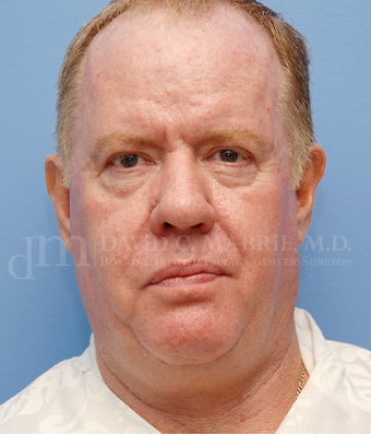 Non-Surgical Chin and Cheek Augmentation Using Radiesse before 658742