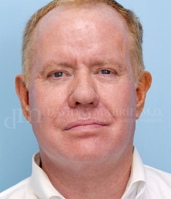 Non-Surgical Chin and Cheek Augmentation Using Radiesse after 658742