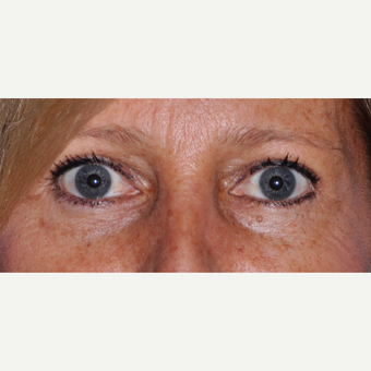45-54 year old woman treated with Eyelid Surgery after 3030494