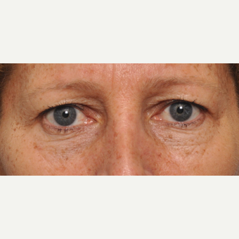 45-54 year old woman treated with Eyelid Surgery before 3030494