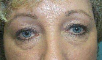 Upper and Lower Lid Blepharoplasty and Cheeklift before 148577