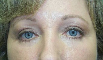 Upper and Lower Lid Blepharoplasty and Cheeklift after 148577