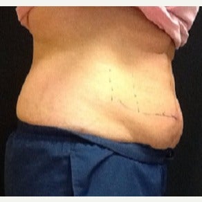 35-44 year old woman treated with CoolSculpting before 2174729