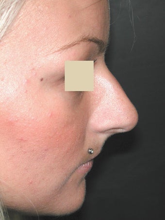 Rhinoplasty before 95659
