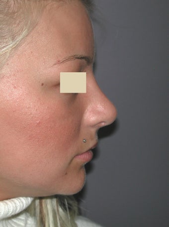 Rhinoplasty after 95659
