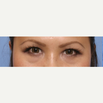 35-44 year old woman treated with Eye Bags Treatment before 3135633
