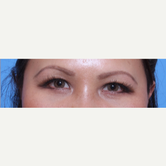 35-44 year old woman treated with Eye Bags Treatment after 3135633