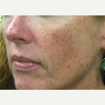 50 year old woman treated with a Vi Peel before 3685085