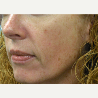 50 year old woman treated with a Vi Peel after 3685085