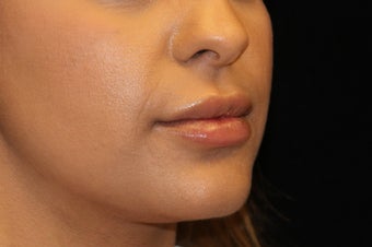 25-34 year old woman treated with Lip Augmentation 3502565