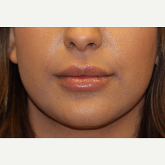 25-34 year old woman treated with Lip Augmentation after 3502565