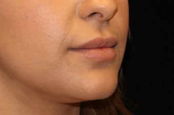 25-34 year old woman treated with Lip Augmentation 3502565
