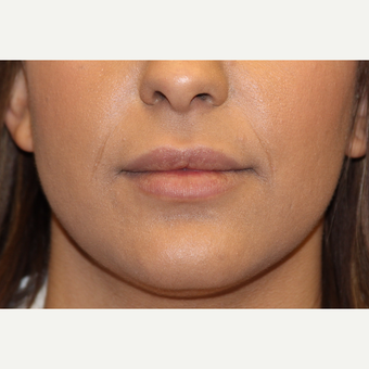 25-34 year old woman treated with Lip Augmentation before 3502565