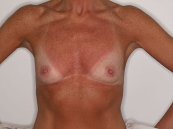 50 yo female for breast enhancement before 1431611