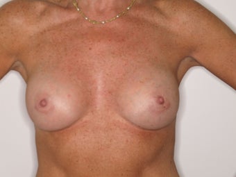 50 yo female for breast enhancement after 1431611